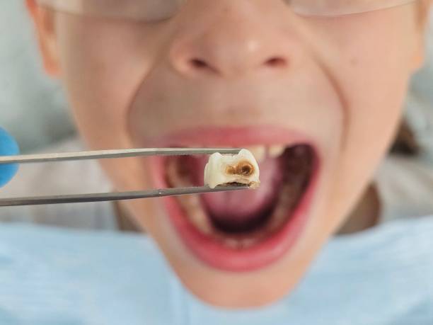 Best Emergency Dentist for Knocked-Out Tooth in Giddings, TX